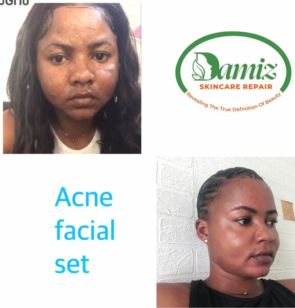 Acne facial set