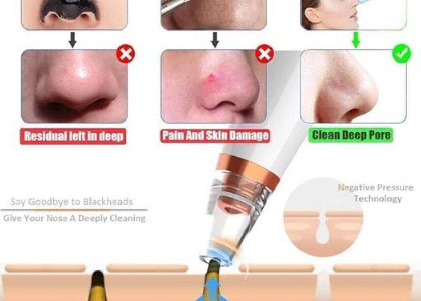 Acne Pimple Pore Vacuum