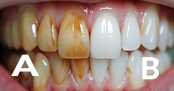 Poudre Dentifrice Blanchissante