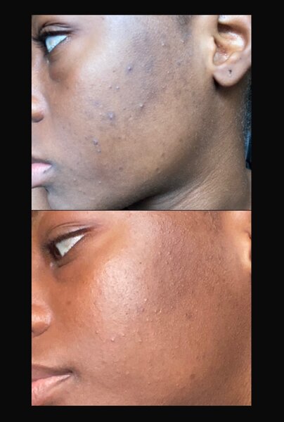 serum et savon anti-taches