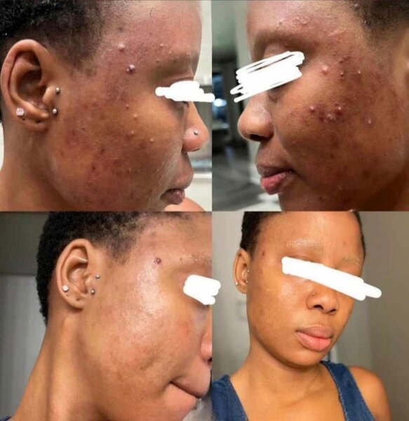 Lotion anti acnée et tâches