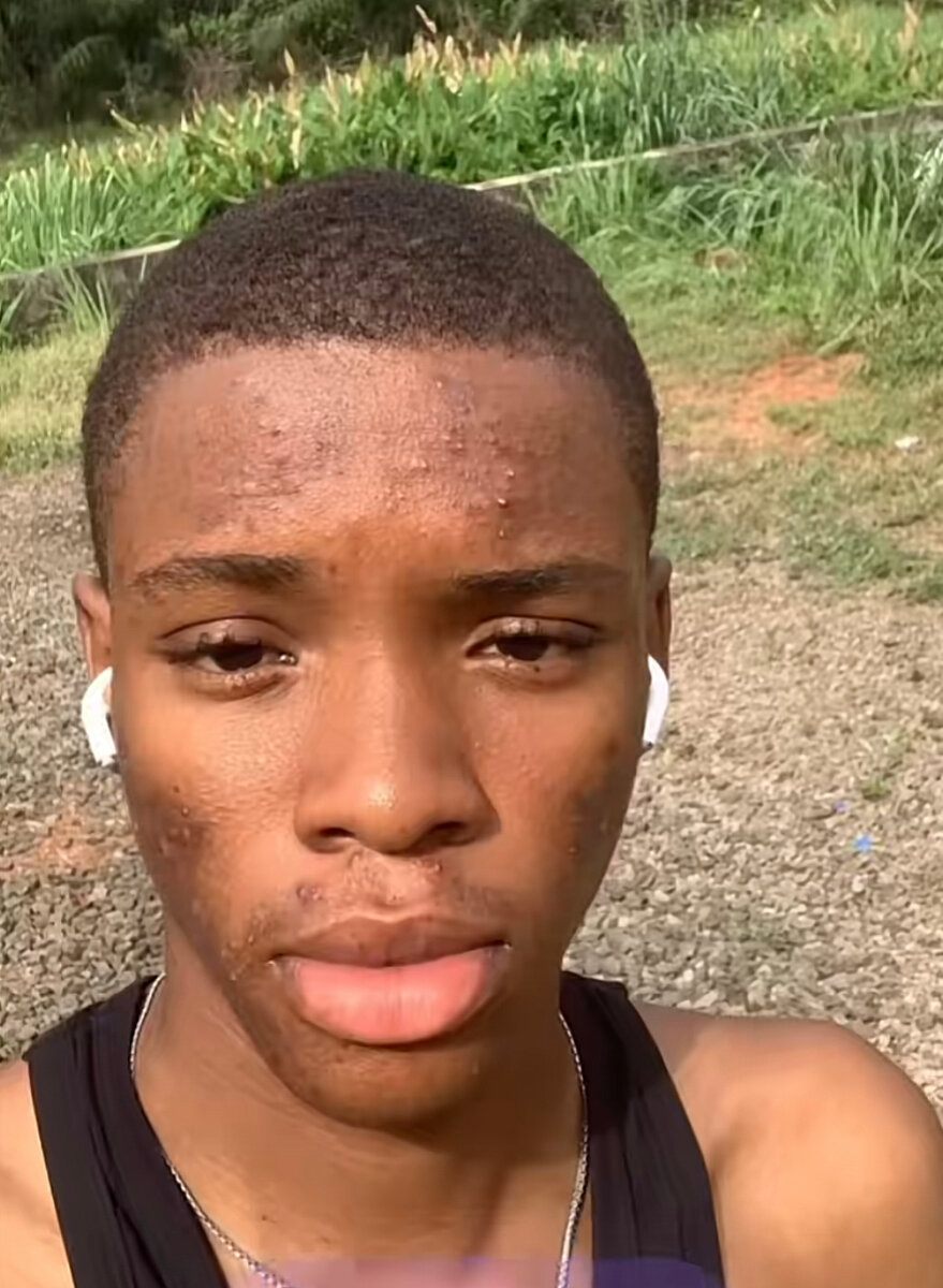 Lotion anti-acné Lysan