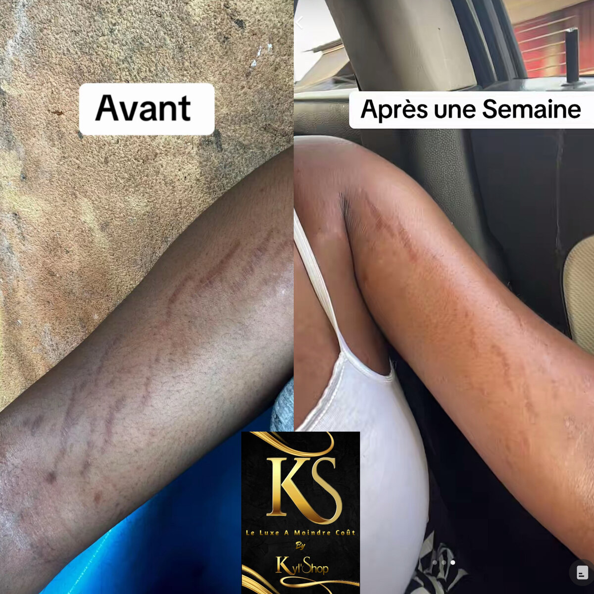 Crème Anti-Vergetures KS