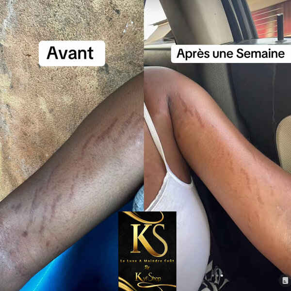 Crème Anti-Vergetures KS