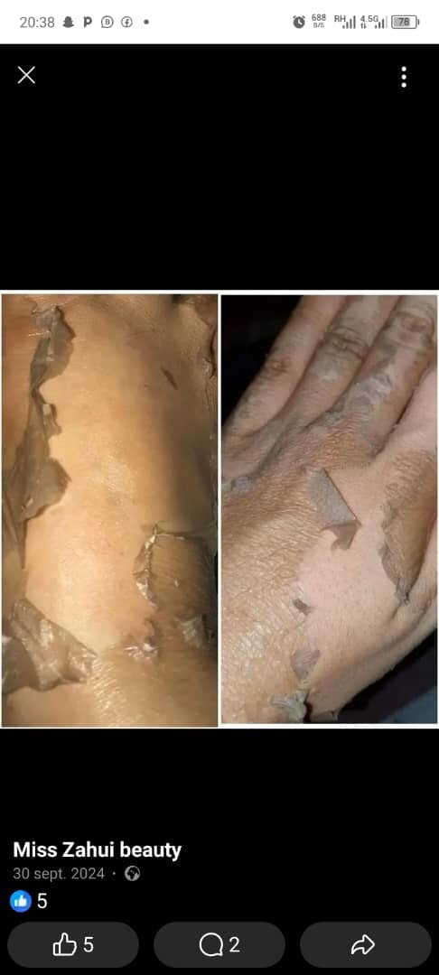 Lotion peeling quinto tâches n