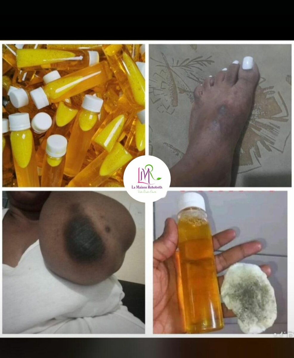 Lotion anti acnée et tâches