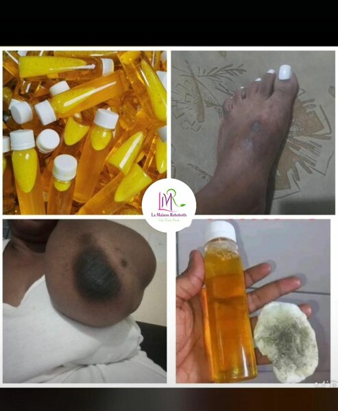 Lotion anti acnée et tâches