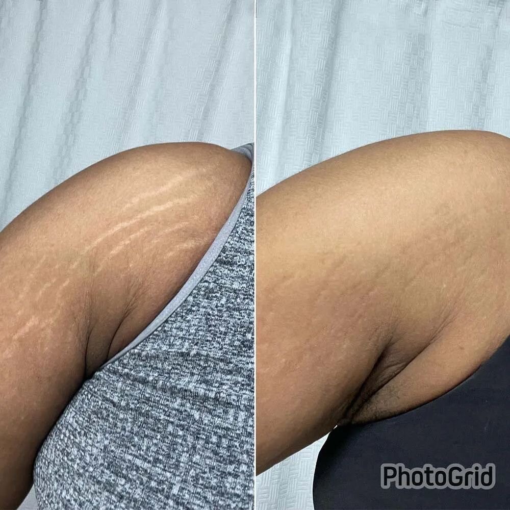 Kit Anti-Vergetures Naturel