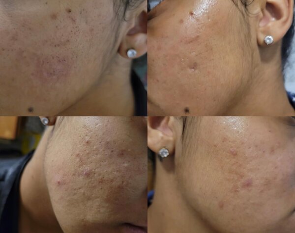 Medicube Zero Pore Pads