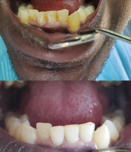 Professional teeth cleaning