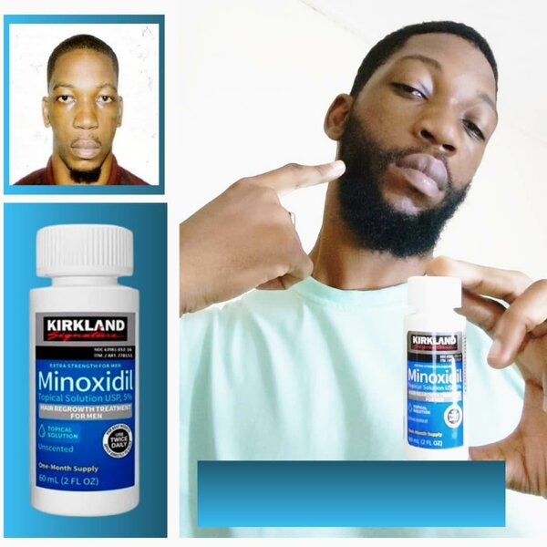 Barbe dense = minoxidil