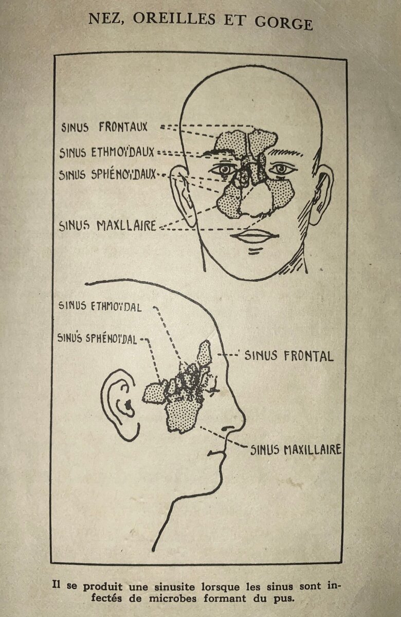 Sinostop - Soulagement Sinusite Naturel