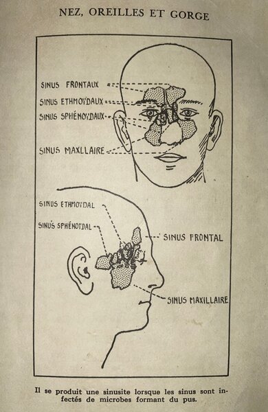 Sinostop - Soulagement Sinusite Naturel