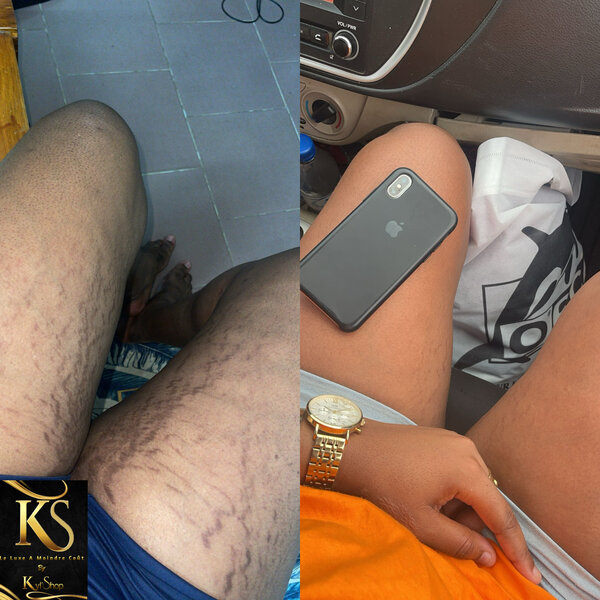 Crème Anti-Vergetures KS