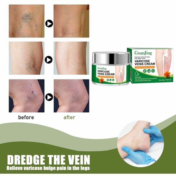 Crème anti-varices