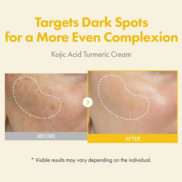 TOSOWOONG Kojic Acid Turmeric Cream 50ml for Dark Spots & Hyperpigmentation